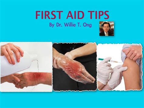 First aid sa napaso, nasunog o naputukan .